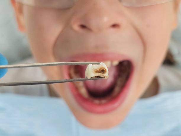 Best Emergency Dentist for Knocked-Out Tooth in Lakeland, TN